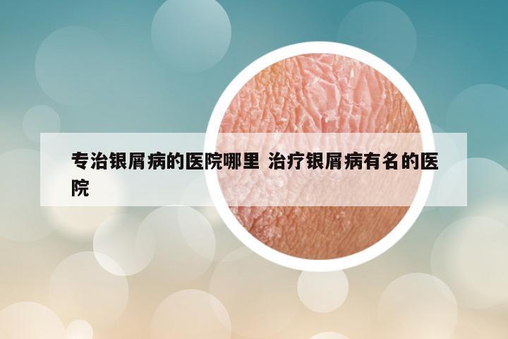 专治银屑病的医院哪里 治疗银屑病有名的医院
