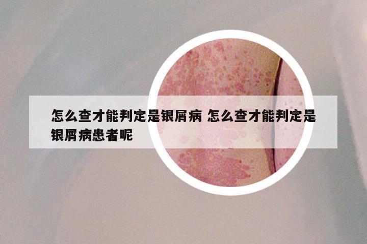怎么查才能判定是银屑病 怎么查才能判定是银屑病患者呢