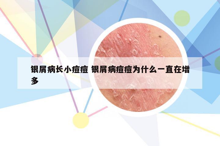 银屑病长小痘痘 银屑病痘痘为什么一直在增多