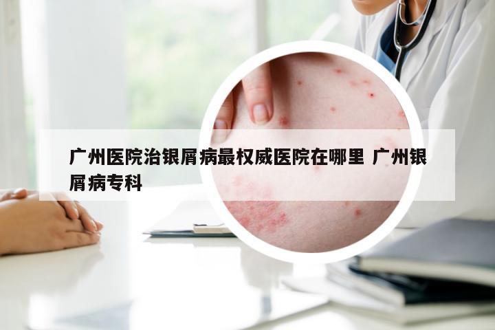 广州医院治银屑病最权威医院在哪里 广州银屑病专科