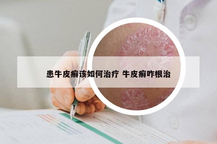 患牛皮癣该如何治疗 牛皮癣咋根治