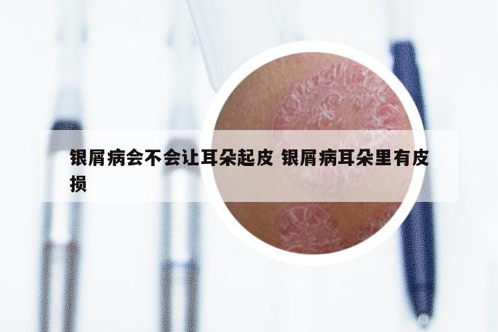 银屑病会不会让耳朵起皮 银屑病耳朵里有皮损