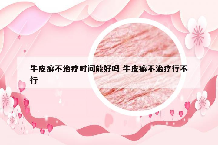 牛皮癣不治疗时间能好吗 牛皮癣不治疗行不行