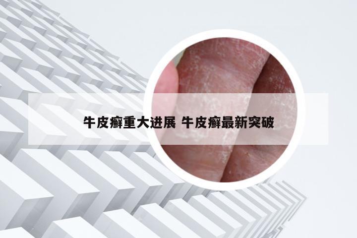 牛皮癣重大进展 牛皮癣最新突破