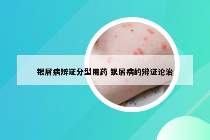 银屑病辩证分型用药 银屑病的辨证论治