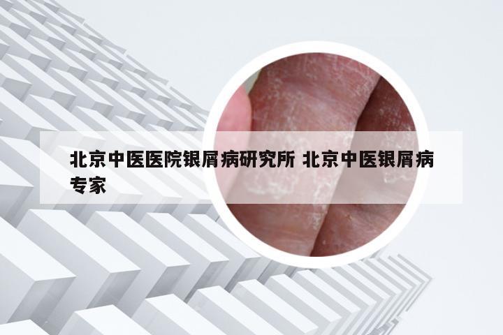 北京中医医院银屑病研究所 北京中医银屑病专家