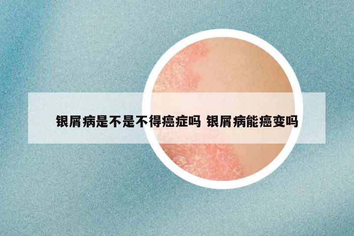 银屑病是不是不得癌症吗 银屑病能癌变吗