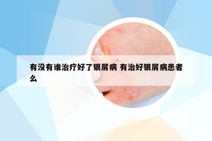 有没有谁治疗好了银屑病 有治好银屑病患者么