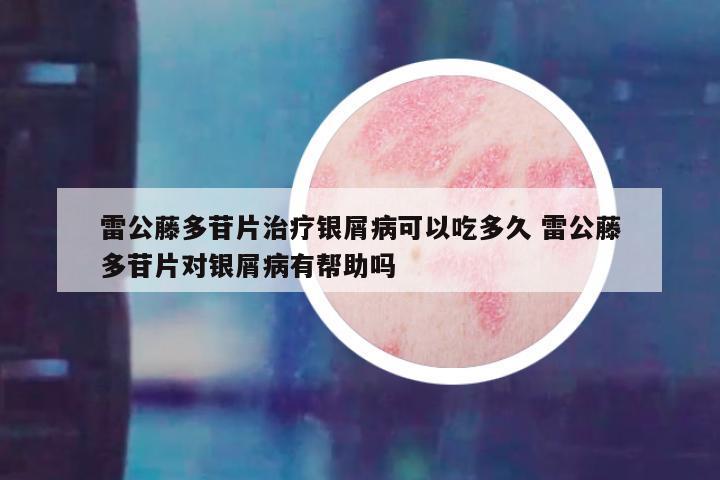雷公藤多苷片治疗银屑病可以吃多久 雷公藤多苷片对银屑病有帮助吗