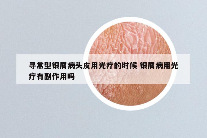 寻常型银屑病头皮用光疗的时候 银屑病用光疗有副作用吗