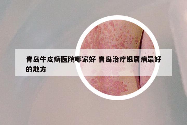 青岛牛皮癣医院哪家好 青岛治疗银屑病最好的地方