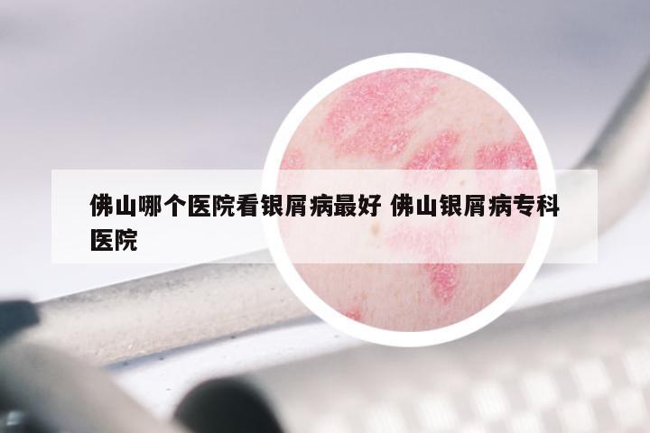 佛山哪个医院看银屑病最好 佛山银屑病专科医院