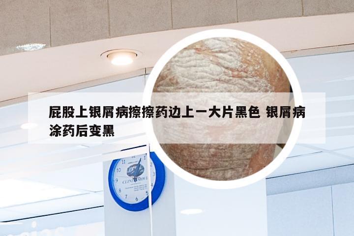 屁股上银屑病擦擦药边上一大片黑色 银屑病涂药后变黑