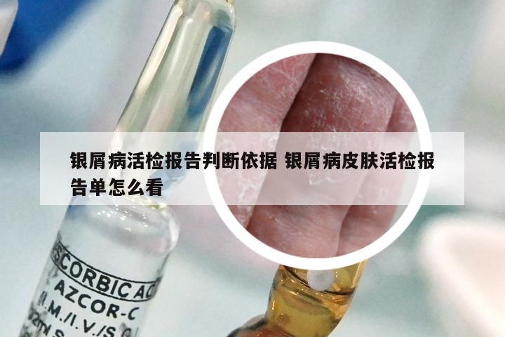 银屑病活检报告判断依据 银屑病皮肤活检报告单怎么看