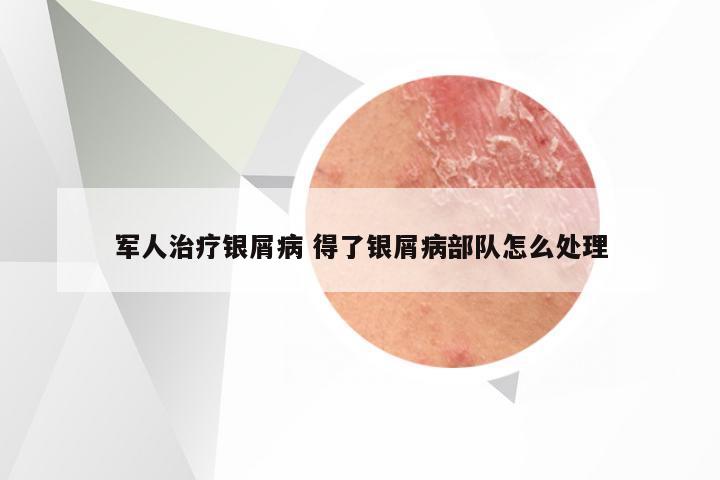 军人治疗银屑病 得了银屑病部队怎么处理