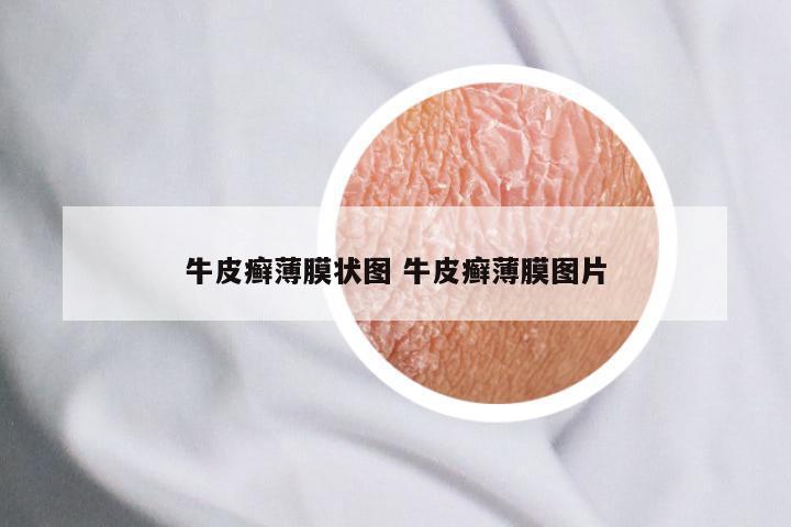 牛皮癣薄膜状图 牛皮癣薄膜图片
