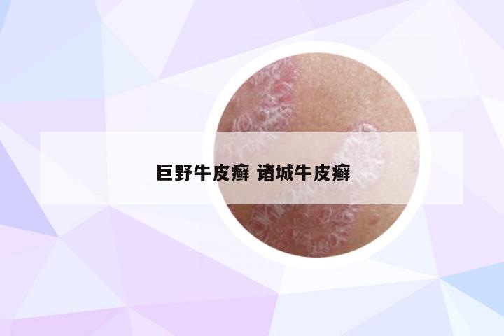 巨野牛皮癣 诸城牛皮癣