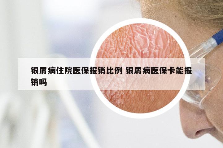 银屑病住院医保报销比例 银屑病医保卡能报销吗
