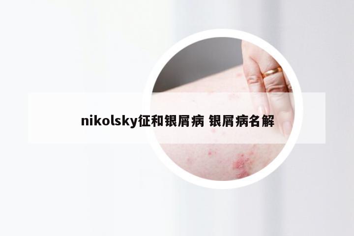 nikolsky征和银屑病 银屑病名解