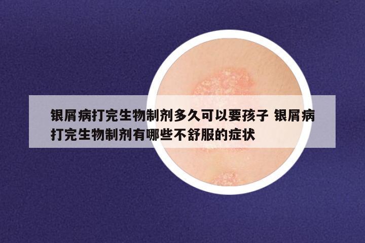 银屑病打完生物制剂多久可以要孩子 银屑病打完生物制剂有哪些不舒服的症状