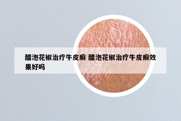 醋泡花椒治疗牛皮癣 醋泡花椒治疗牛皮癣效果好吗
