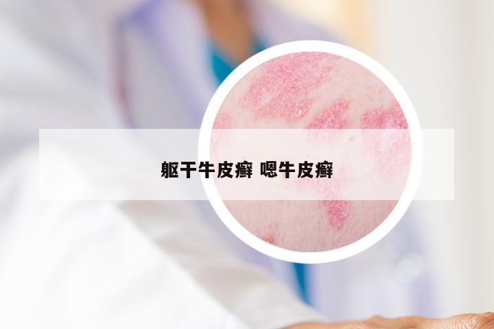 躯干牛皮癣 嗯牛皮癣