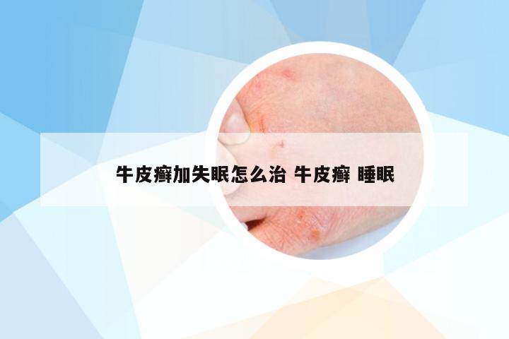 牛皮癣加失眠怎么治 牛皮癣 睡眠