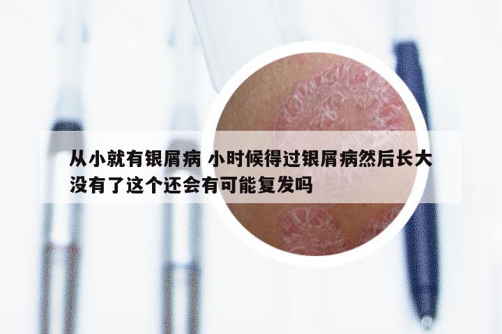 从小就有银屑病 小时候得过银屑病然后长大没有了这个还会有可能复发吗