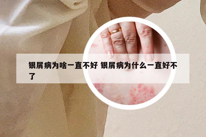 银屑病为啥一直不好 银屑病为什么一直好不了