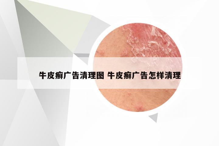 牛皮癣广告清理图 牛皮癣广告怎样清理