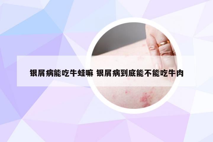 银屑病能吃牛蛙嘛 银屑病到底能不能吃牛肉