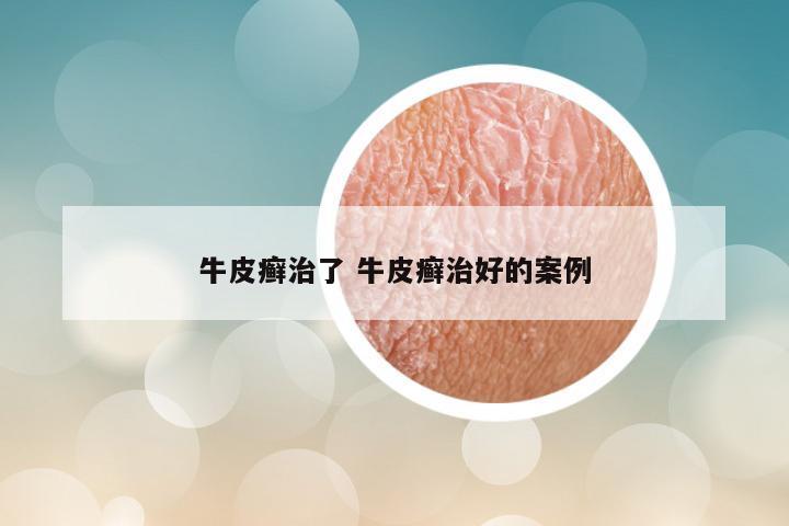 牛皮癣治了 牛皮癣治好的案例