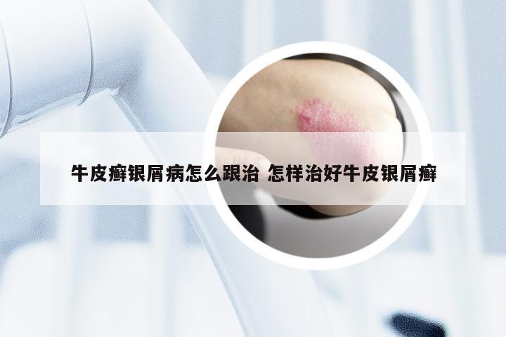 牛皮癣银屑病怎么跟治 怎样治好牛皮银屑癣