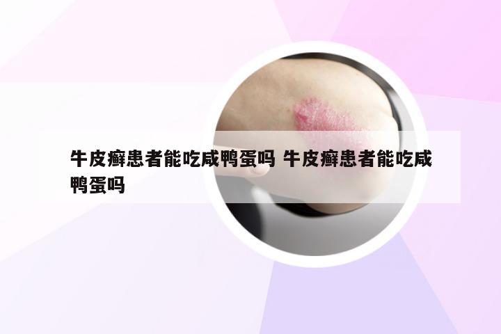 牛皮癣患者能吃咸鸭蛋吗 牛皮癣患者能吃咸鸭蛋吗