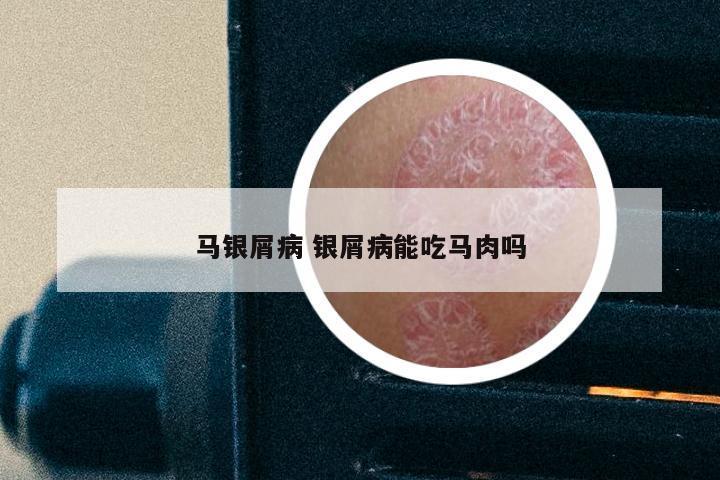 马银屑病 银屑病能吃马肉吗