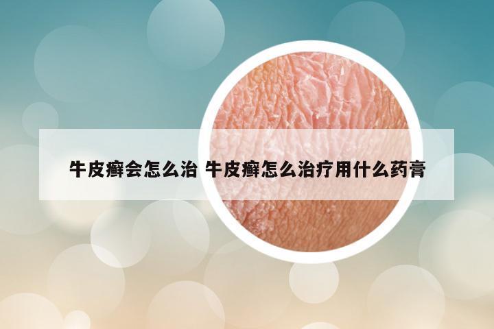 牛皮癣会怎么治 牛皮癣怎么治疗用什么药膏