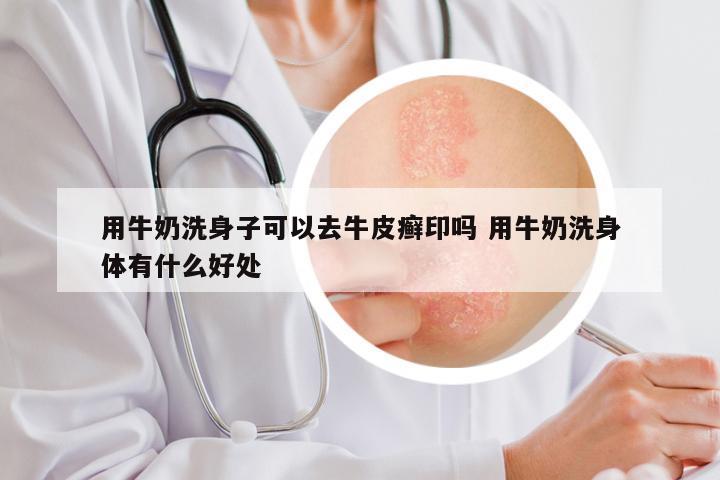 用牛奶洗身子可以去牛皮癣印吗 用牛奶洗身体有什么好处
