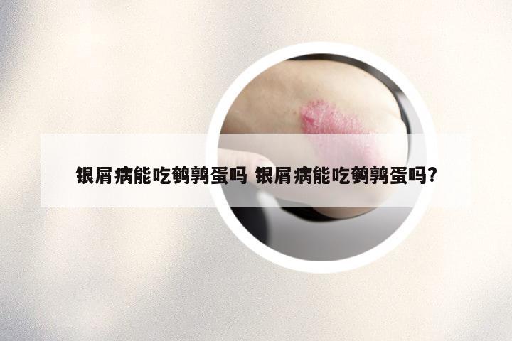 银屑病能吃鹌鹑蛋吗 银屑病能吃鹌鹑蛋吗?