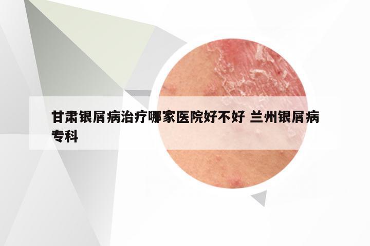 甘肃银屑病治疗哪家医院好不好 兰州银屑病专科