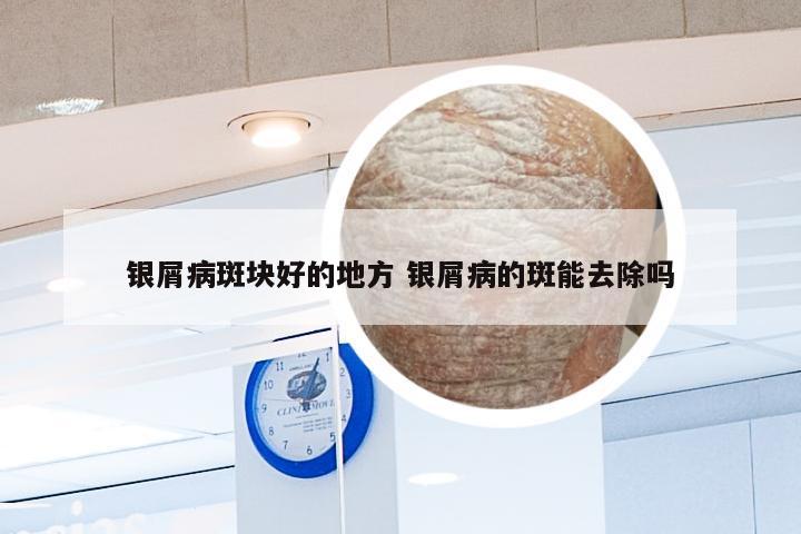 银屑病斑块好的地方 银屑病的斑能去除吗