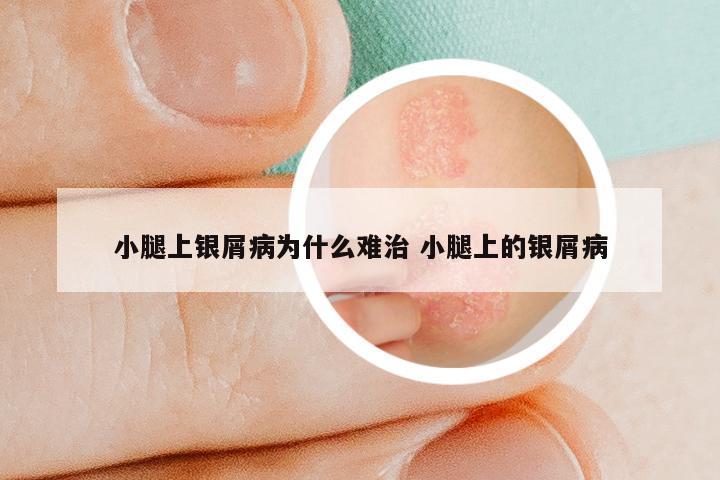 小腿上银屑病为什么难治 小腿上的银屑病