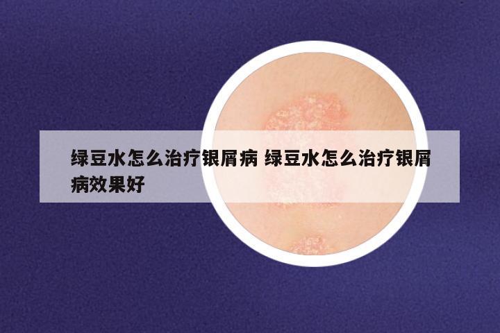绿豆水怎么治疗银屑病 绿豆水怎么治疗银屑病效果好