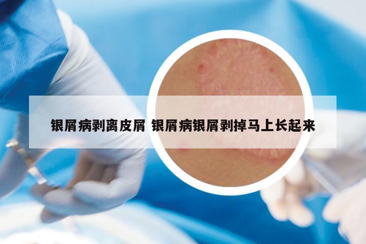 银屑病剥离皮屑 银屑病银屑剥掉马上长起来