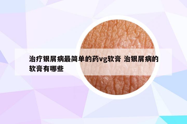 治疗银屑病最简单的药vg软膏 治银屑病的软膏有哪些