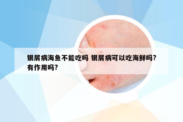 银屑病海鱼不能吃吗 银屑病可以吃海鲜吗?有作用吗?