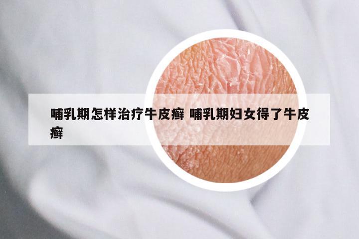 哺乳期怎样治疗牛皮癣 哺乳期妇女得了牛皮癣