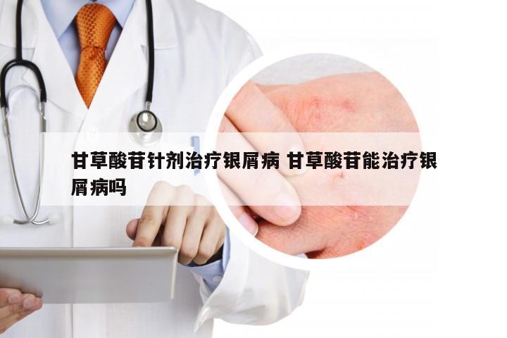 甘草酸苷针剂治疗银屑病 甘草酸苷能治疗银屑病吗