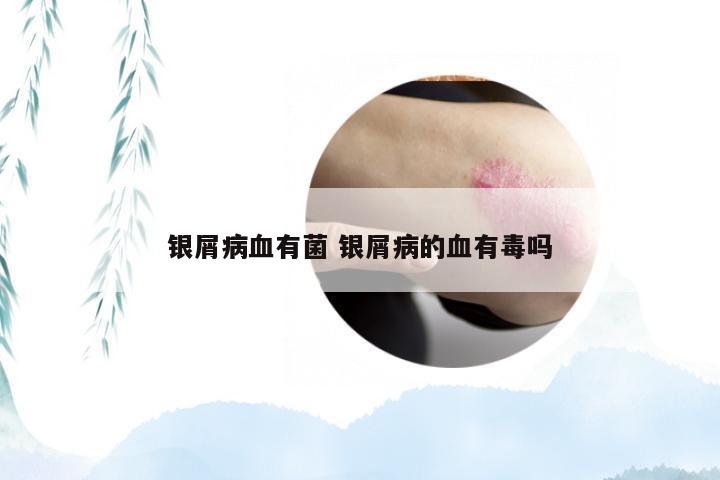 银屑病血有菌 银屑病的血有毒吗