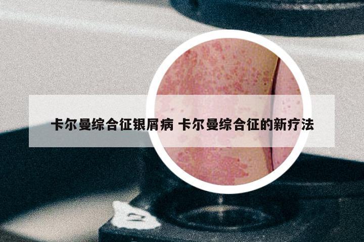 卡尔曼综合征银屑病 卡尔曼综合征的新疗法