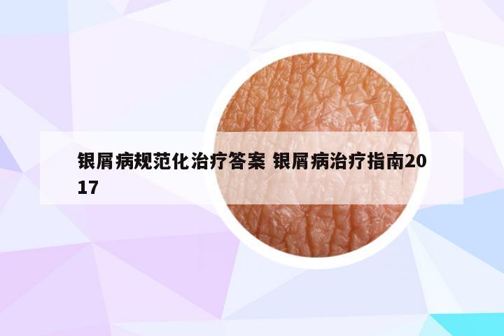 银屑病规范化治疗答案 银屑病治疗指南2017